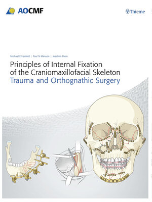 cover image of Principles of Internal Fixation of the Craniomaxillofacial Skeleton